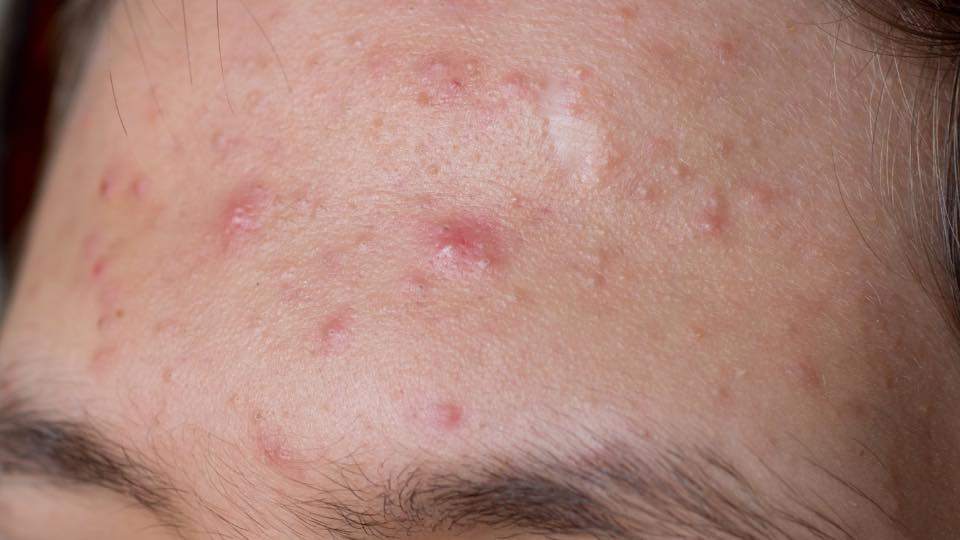 MỤN VÙNG TRÁN- NGUYÊN NHÂN VÀ CÁCH ĐIỀU TRỊ HIỆU QUẢ