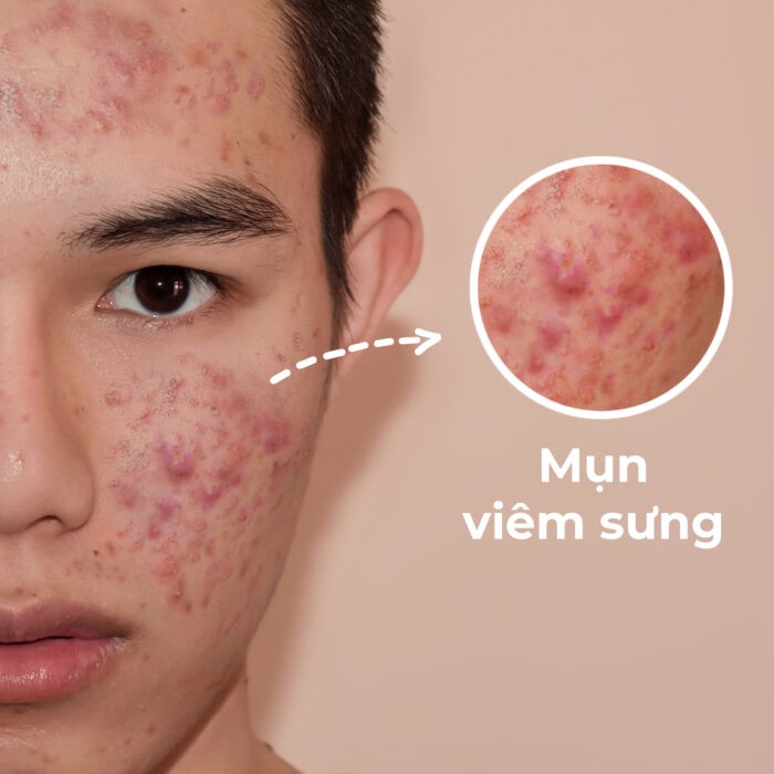 MỤN VIÊM- NGUYÊN NHÂN VÀ PHƯƠNH PHÁP ĐIỀU TRỊ HIỆU QUẢ