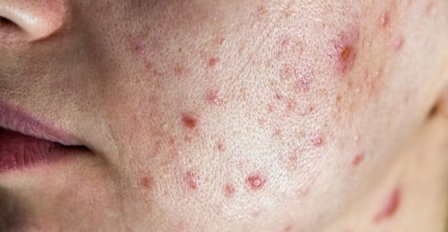 MỤN VÙNG MÁ- KHI HỆ TIÊU HOÁ VÀ MÔI TRƯỜNG TÁC ĐỘNG ĐẾN DA