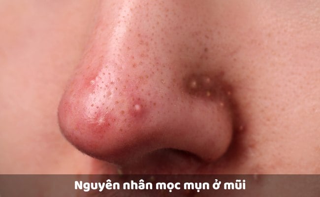 MỤN VÙNG MŨI VÌ SAO LÀ ’ĐIỂM NÓNG’  CỦA MỤN ĐẦU ĐEN VÀ VIÊM