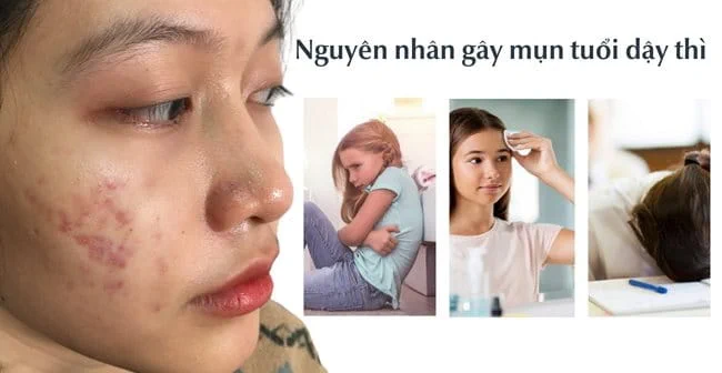 MỤN TUỔI DẬY THÌ VÌ SAO KHÓ KIỂM SOÁT