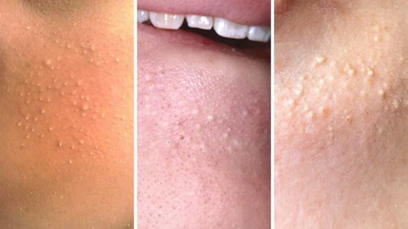 MỤN ĐẦU TRẮNG – NGUYÊN NHÂN VÀ CÁCH KHẮC PHỤC
