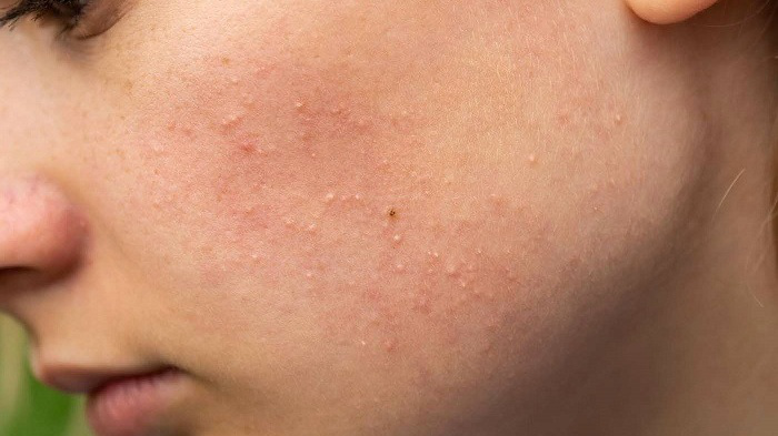 MỤN DỊ ỨNG MỸ PHẨM- NHẬN BIẾT VÀ XỬ LÝ ĐÚNG CÁCH