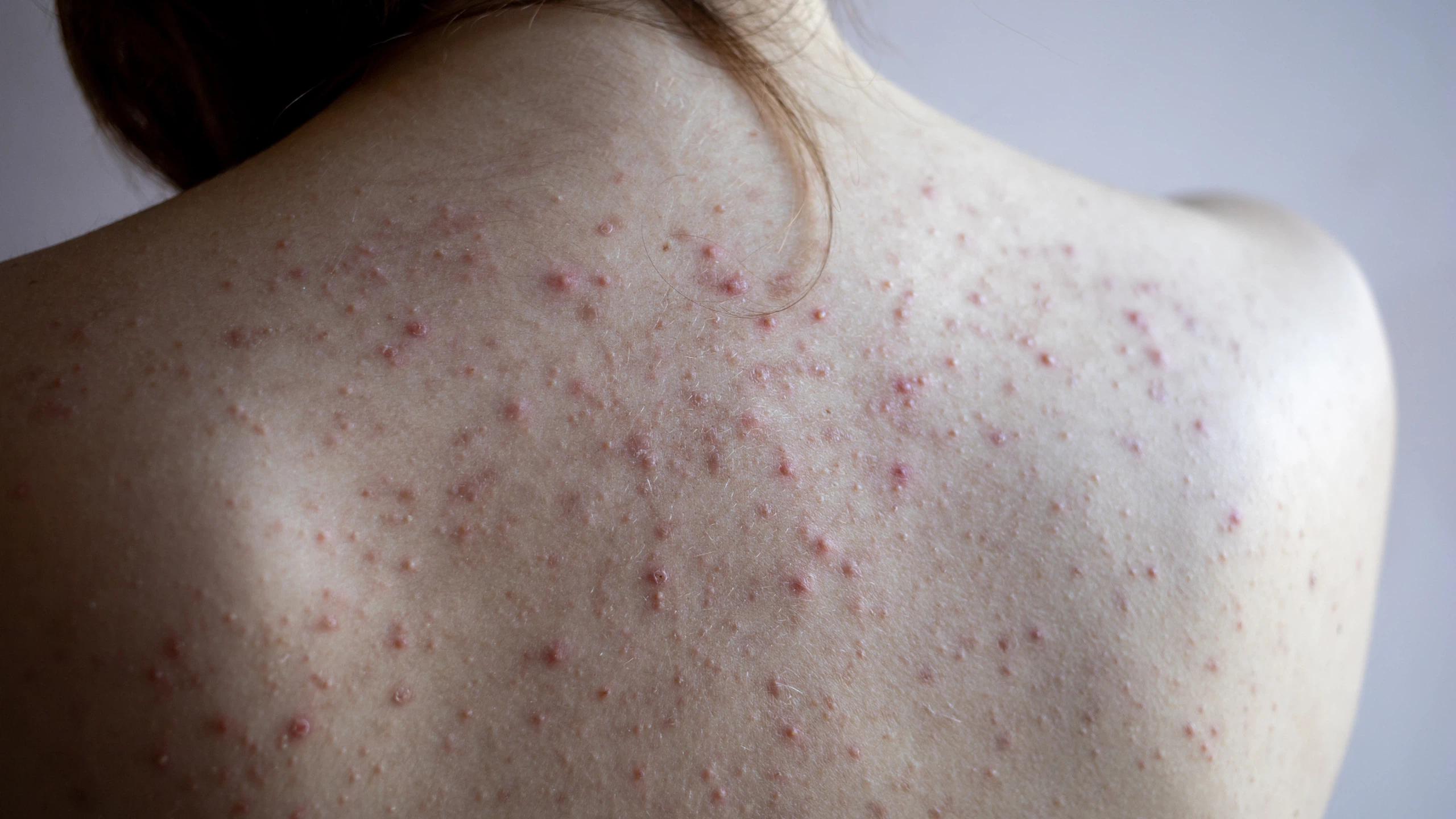 MỤN Ở LƯNG- NGUYÊN NHÂN VÀ CÁCH ĐIỀU TRỊ DỨT ĐIỂM TẠI LIGI 