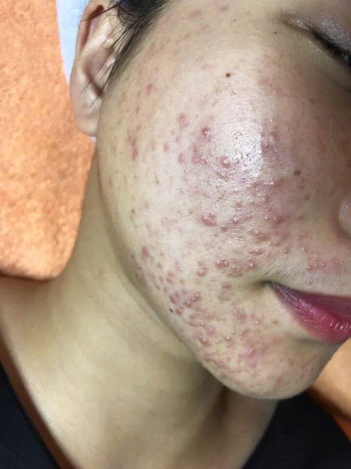 NGUYÊN NHÂN GÂY MỤN NỘI TIẾT VÀ CÁCH NHẬN BIẾT