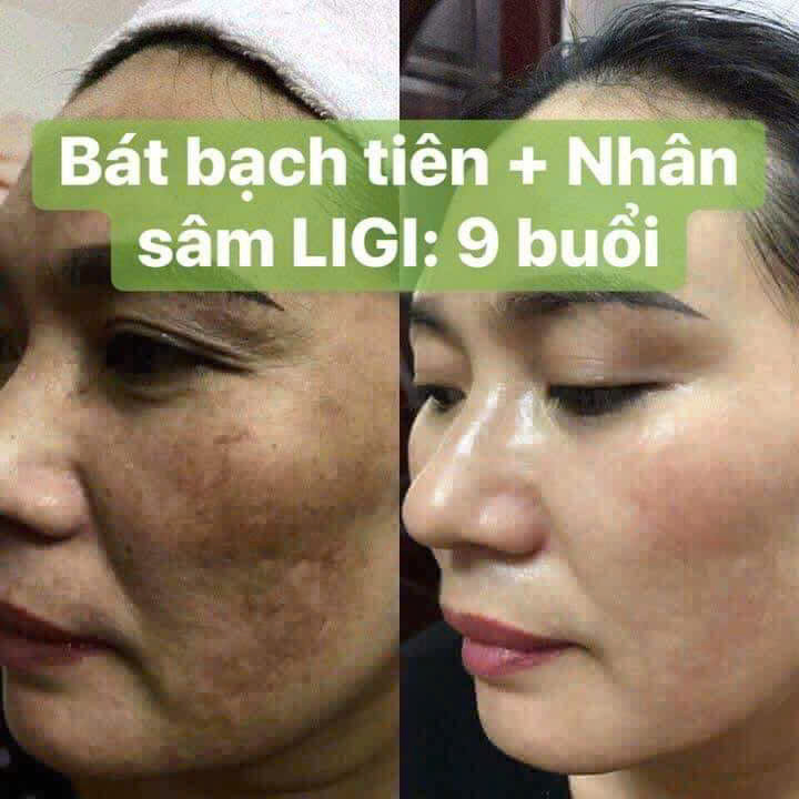 Chọn đúng sản phẩm trị nám – Bước đầu tiên quyết định 80% hiệu quả điều trị