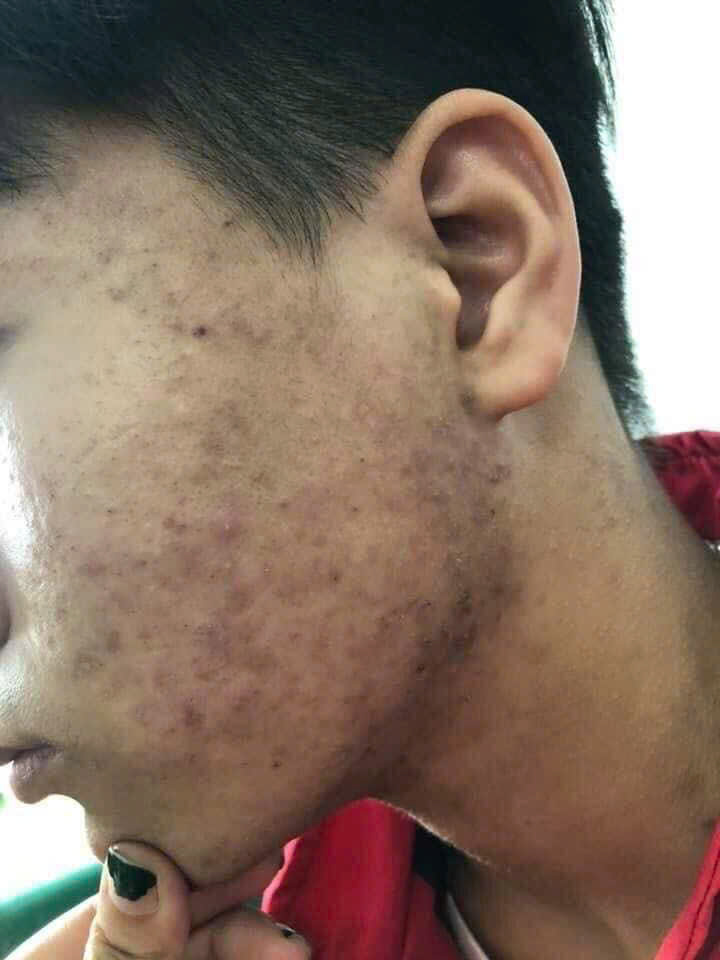 MỤN ĐẦU ĐEN –NGUYÊN NHÂN VÀ CÁCH ĐIỀU TRỊ AN TOÀN